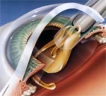лечение катаракты
